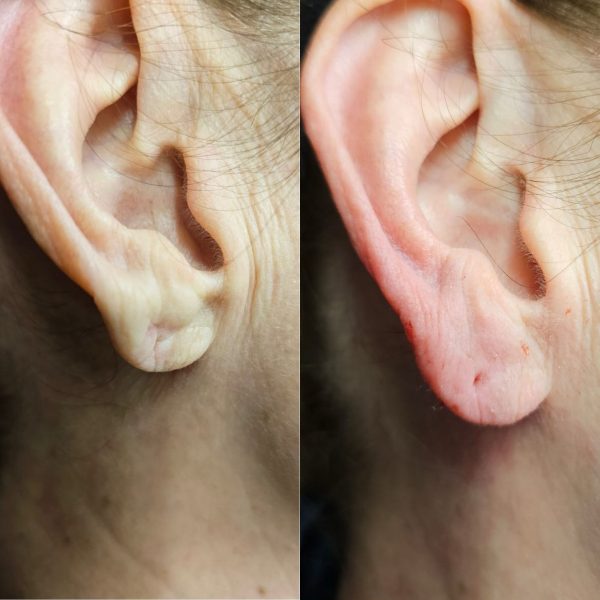 Earlobe Filler 1