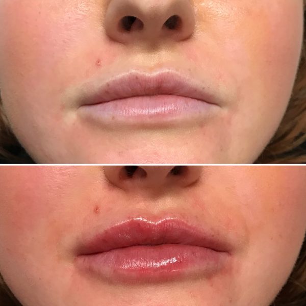 Lip Filler 1