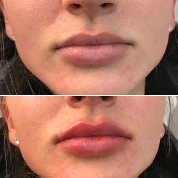 Lip Filler 10