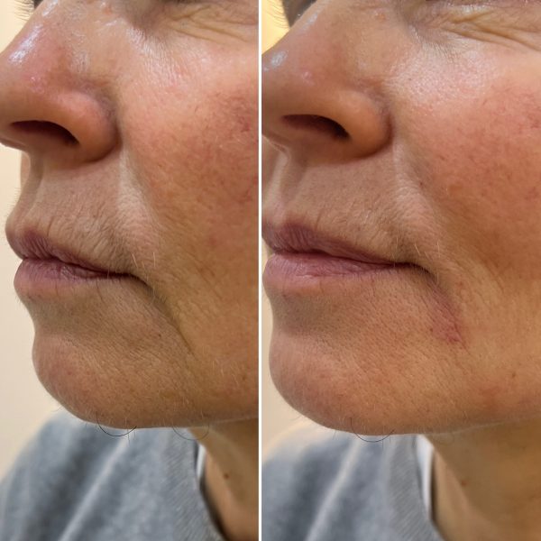 Lower Facial Rejuvenation 1
