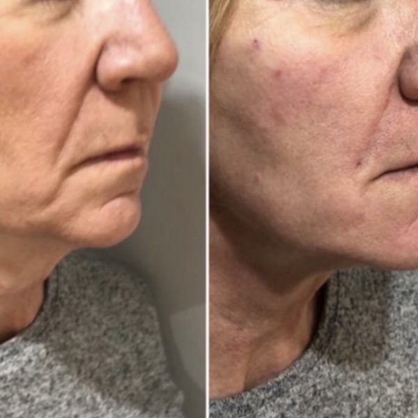 Lower Facial Rejuvenation 2
